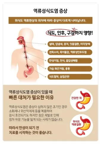 식도염에 좋은 음식 안좋은 음식_4