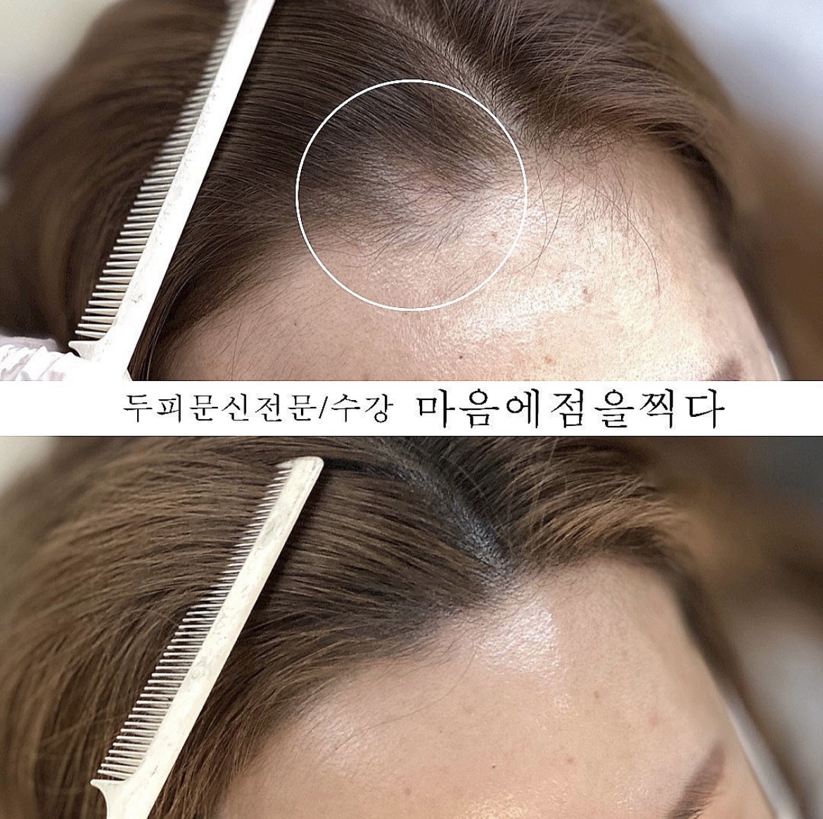 마음에점을찍다두피SMP 이미지
