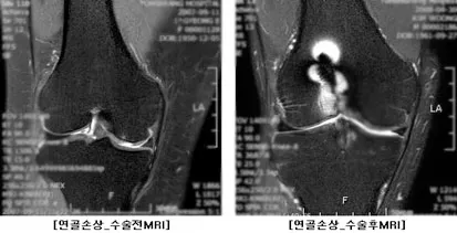 무릎 연골 손상 증상