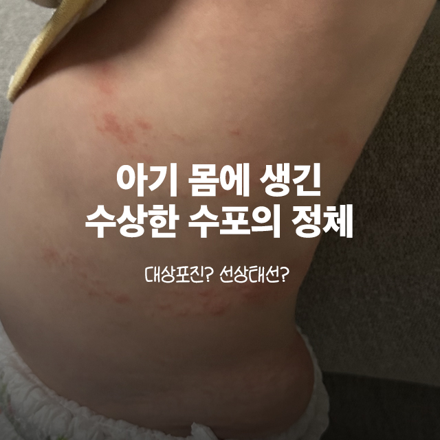 아기 몸에 생긴 수상한 수포의 정체 대표 이미지
