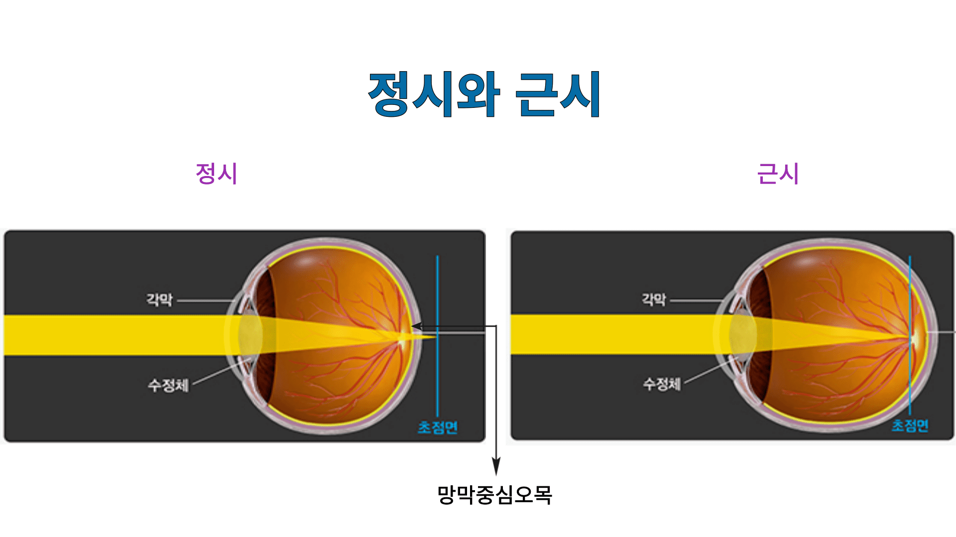 정상 시력과 근시의 차이를 설명하는 도표입니다. 왼쪽은 정상 시력을 나타내며, 빛이 각막과 수정체를 통과해 망막 중심에 정확하게 초점이 맞춰지는 모습을 보여줍니다. 오른쪽은 근시를 설명하며, 눈이 길어져 빛이 망막 앞쪽에 초점이 맞춰지는 과정을 나타냅니다.