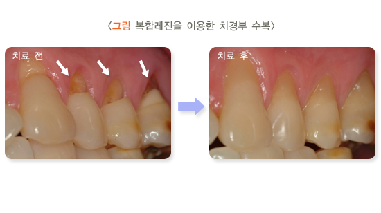 치경부마모증-복합레진수복-국가건강정보포털이미지