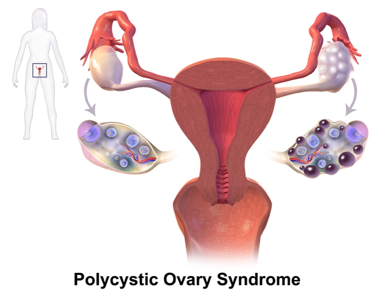 다낭성 난소 증후군(PCOS)