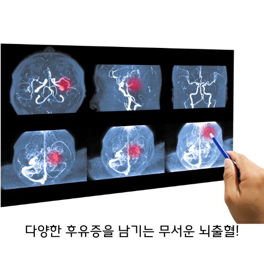  뇌출혈 다양한 후유증을 남기는 무서운 병!