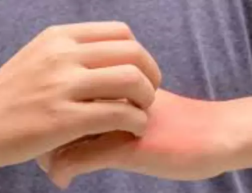 대상포진-초기증상-원인-건강