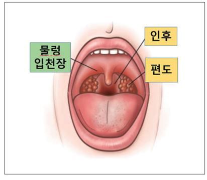 인후염 증상