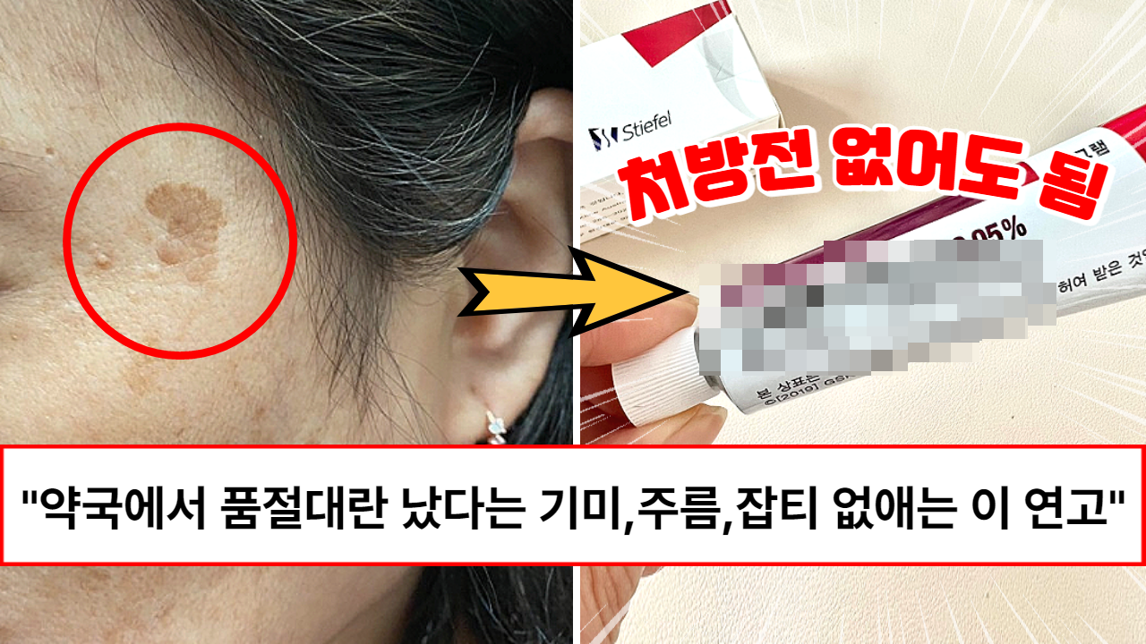 “진심 레이저에 헛돈 쓰지 마세요” 피부과 레이저 시술 없이 집에서 기미, 잡티, 주름 없앨 수 있는 강력한 연고