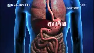 대장내시경 용종제거 후 식사 식단조절_8