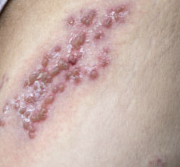 남성의 헤르페스 2형