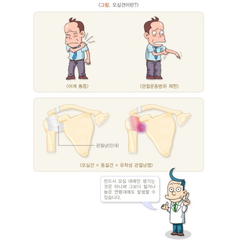 오십견
