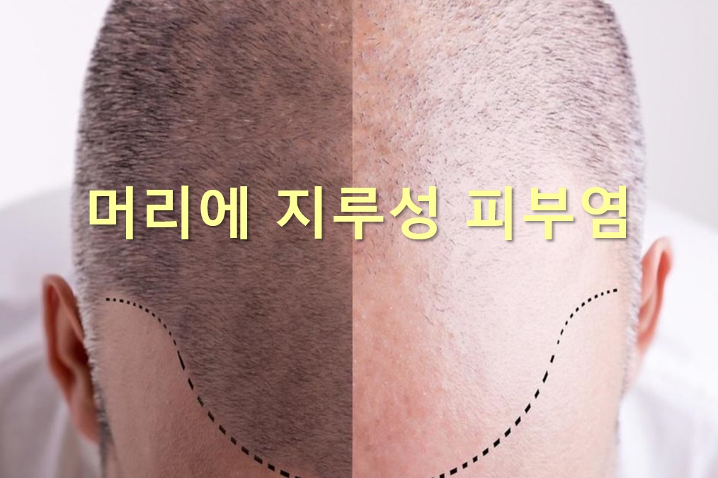  머리에 뽀드락지 나는 이유와 머리에 지루성 피부염 증상