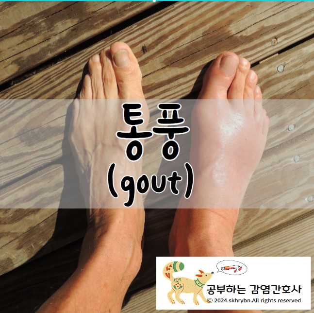 통풍(gout), 통풍 원인과 증상, 통풍에 좋은 음식