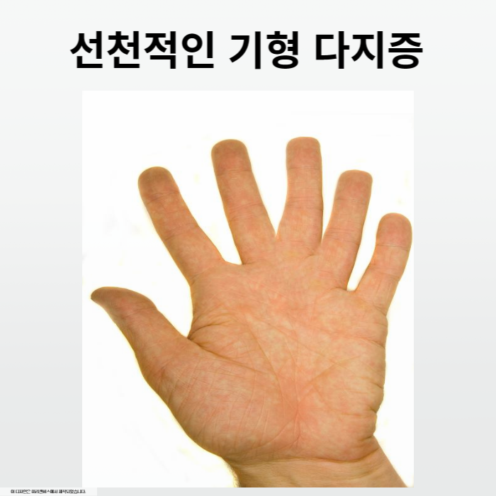 선천적인기형 다지증