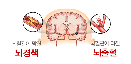 뇌경색-뇌출혈