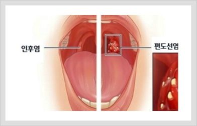 인후염 증상