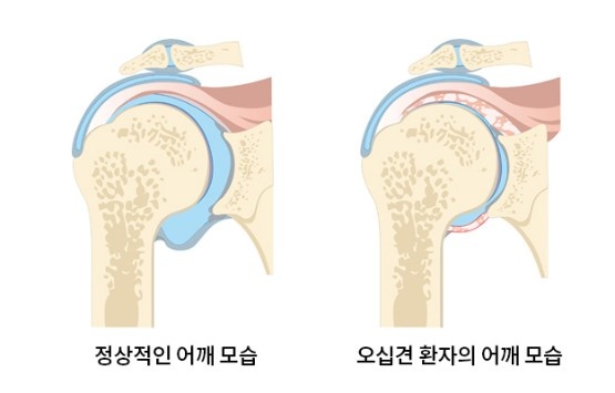 오십견 증상