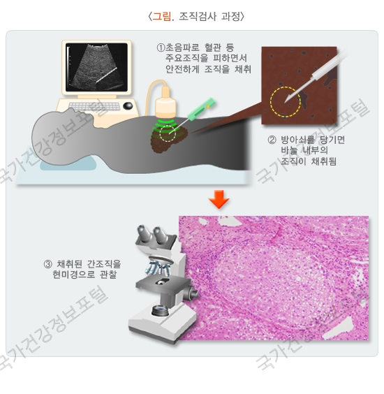 조직 검사