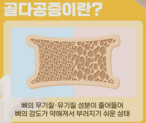  골다공증 국내 현황, 운동 방법, 예방 음식, 그리고 비타민 D 중요성