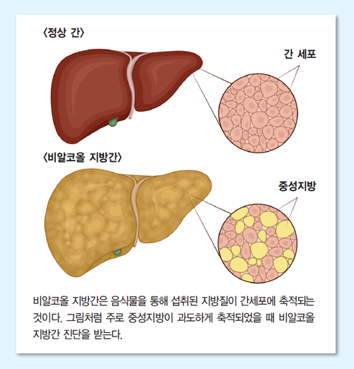 지방간 증상. 치료