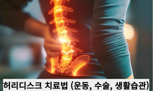 허리디스크 치료법 (운동, 수술, 생활습관)