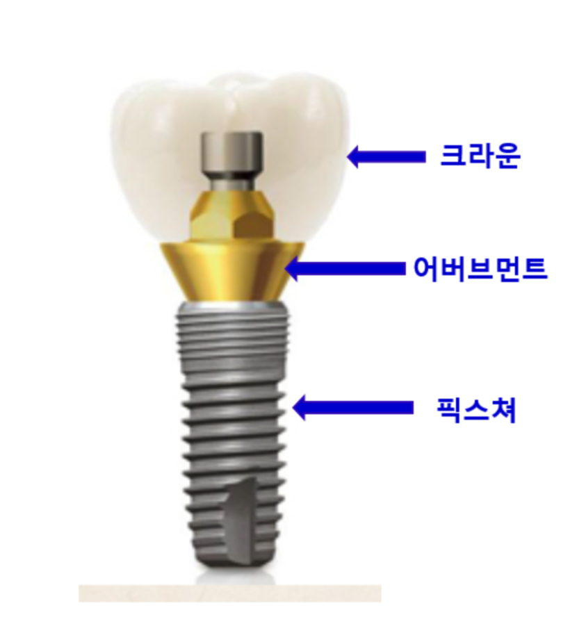 임플란트 구조