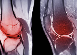 무릎 십자인대 파열 증상