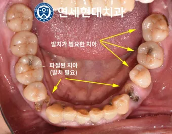 어금니 칫솔 사용법 선택방법 실사용 후기_27