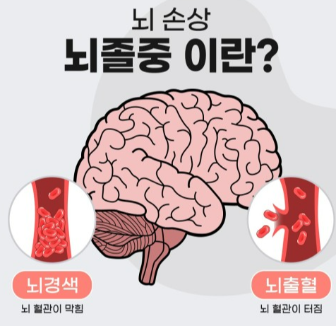  뇌질환 '뇌졸중'에 대한 모든것!