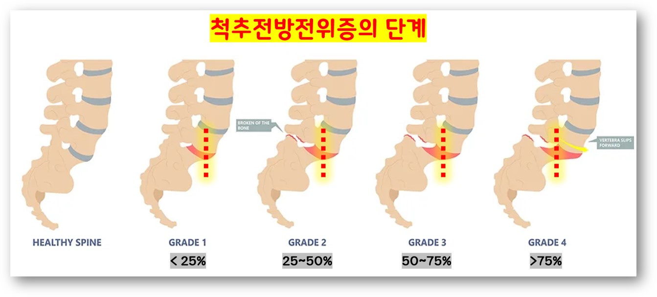 척추 전방전위증 단계