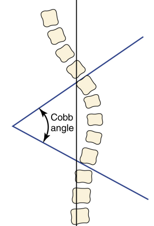 Cobb angle. 콥앵글&#44; 척추 측만증 평가