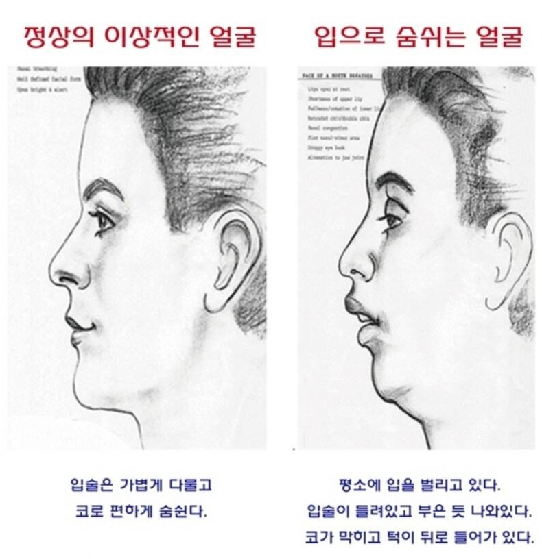 정상의 이상적인 얼굴
입으로 숨쉬는 얼굴
입술은 가볍게 다물고 코로 편하게 숨쉰다.
평소에 입을 벌리고 있다. 입술이 틀려있고 부은 듯 나와있다. 코가 막히고 턱이 뒤로 들어가 있다.