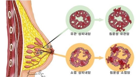  유방암 초기 증상 및 통증, 유방암 자가진단법 알아봤습니다.