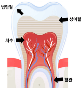  크기가 다른 충치 치아 때우는 재료 및 시술방법