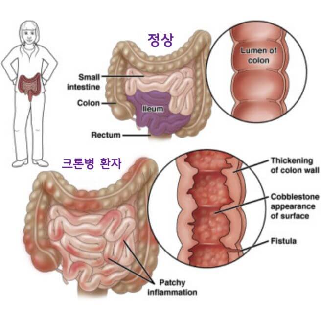 크론병 증상