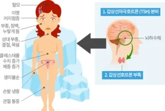 갑상샘 저하증 갑상선 기능저하증 증상 수치 치료_2