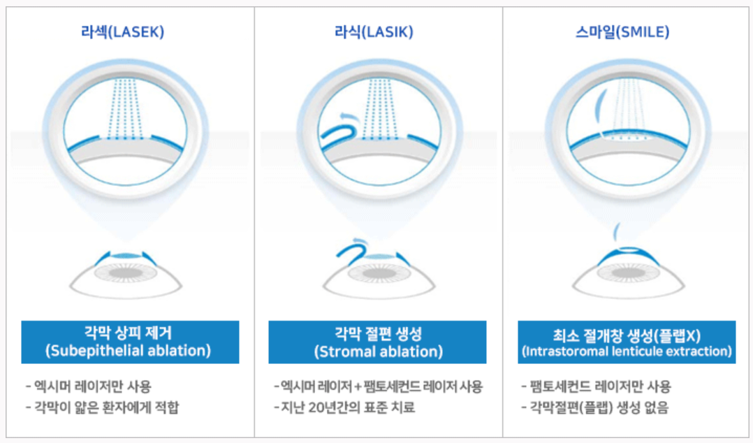  대구 메트로 안과 스마일 라식 내돈내산 5.5년 차 후기