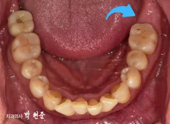 어금니 칫솔 사용법 선택방법 실사용 후기_8