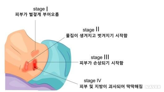 욕창 증상