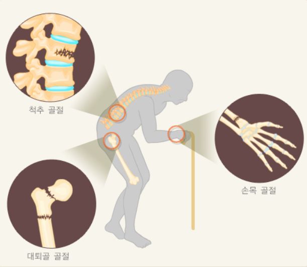 골다공증 증상