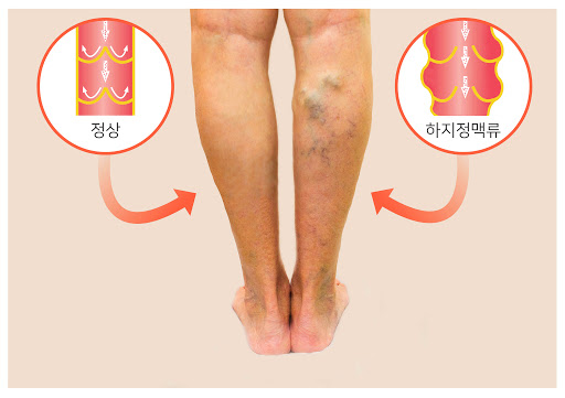 하지정맥류 원인 알고 제때 치료받자 7