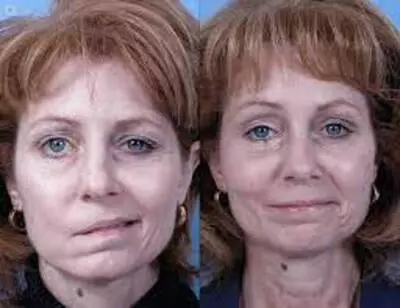 Bell&#39;s palsy-before-after