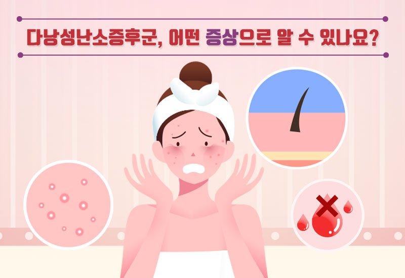 다낭성 난소증후군 사진