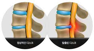 허리디스크 증세