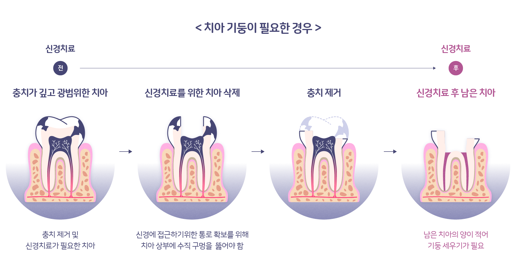 치아 기둥이란? 치과 신경치료 후 포스트 크라운 치료 | 신기행복을심는치과 건강정보 치아 기둥이란? 치과 신경치료 후 포스트 크라운 치료 | 신기행복을심는치과 건강정보