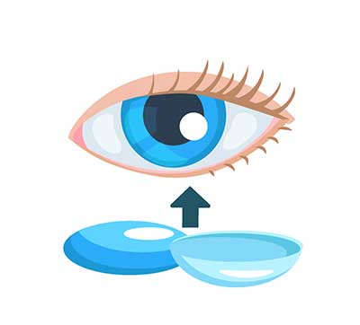 각막염 콘택트렌즈