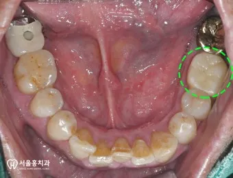 어금니 칫솔 사용법 선택방법 실사용 후기_5