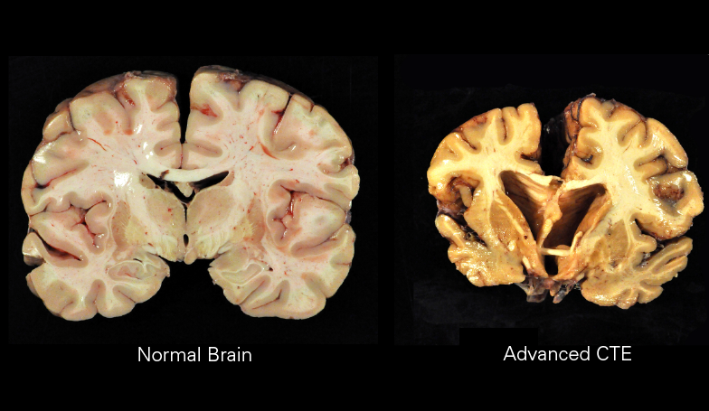  여성 운동선수 반복 뇌 외상 관련 세계최초 치매 사례 확인 Australian researchers confirm world’s first case of dementia linked to repetitive brain trauma...