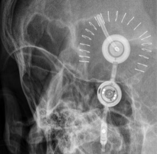 progav&amp;#44; skull x-ray