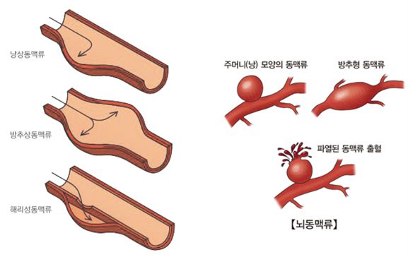 뇌동맥류 증상