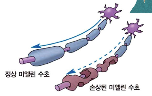 다발성 경화증 질환 사진